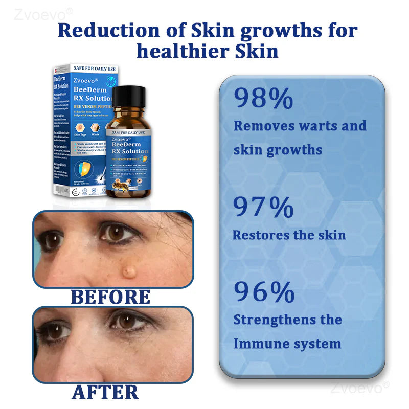 BeeDerm RX Removedor de Verrugas e Manchas