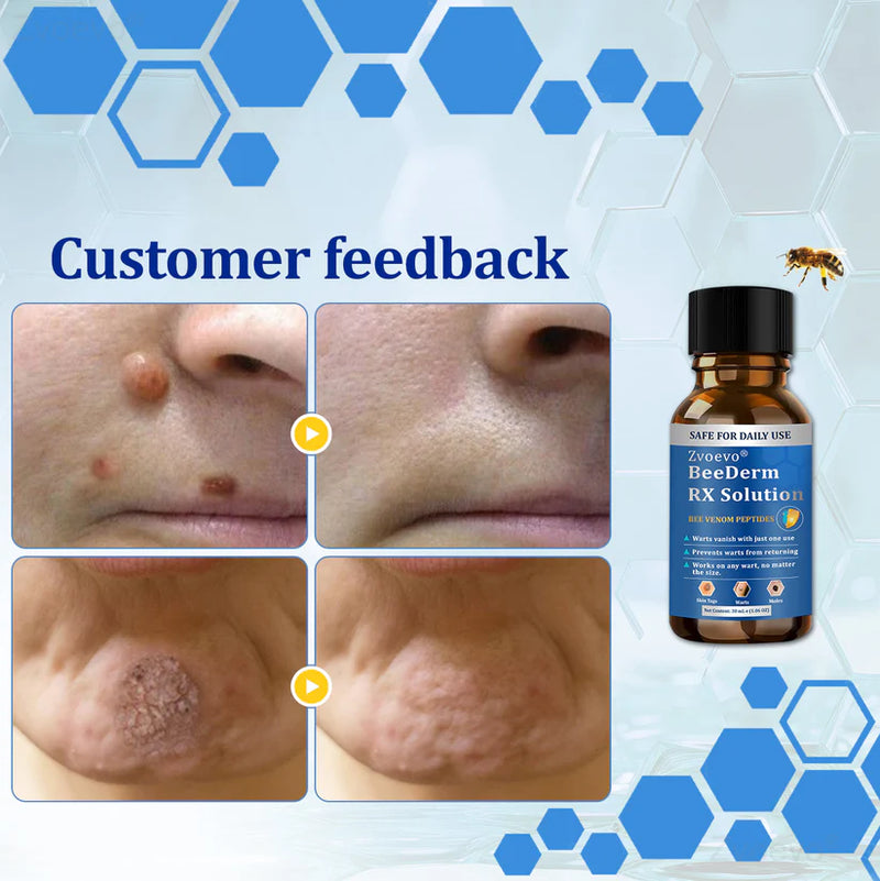 BeeDerm RX Removedor de Verrugas e Manchas