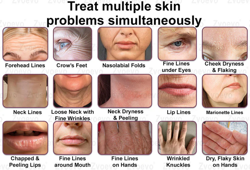 Botox Lip