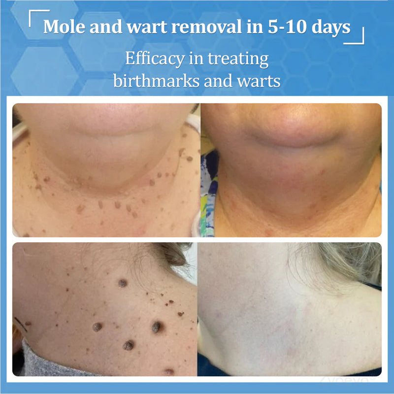 BeeDerm RX Removedor de Verrugas e Manchas