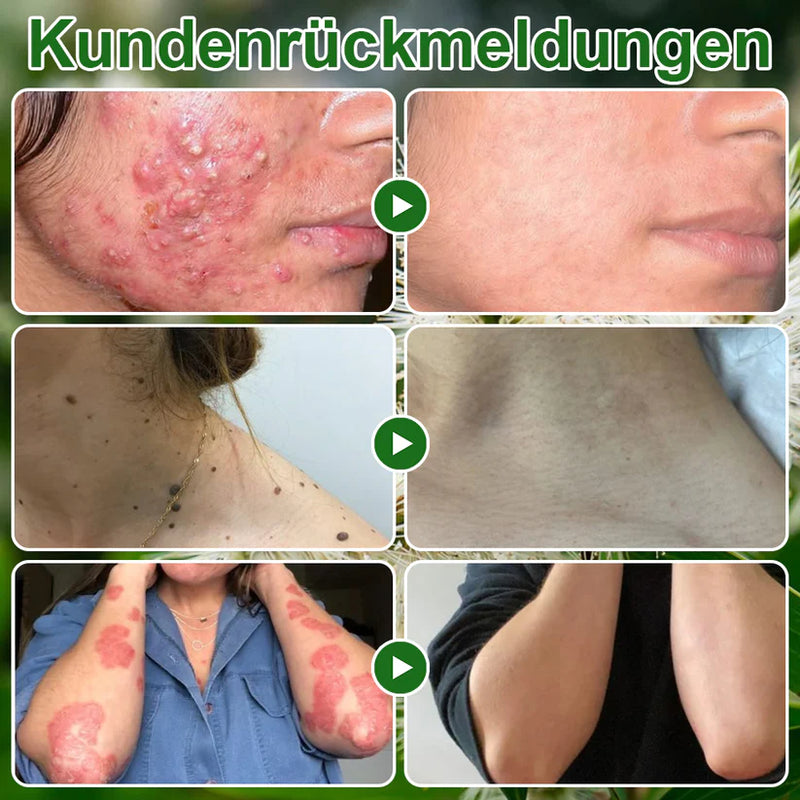 Teebaumol Cream