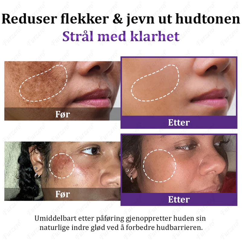 MelanEX Creme Anti-Hiperpigmentação