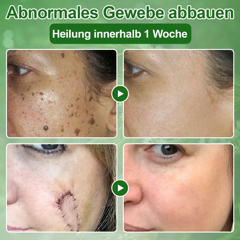 Teebaumol Cream