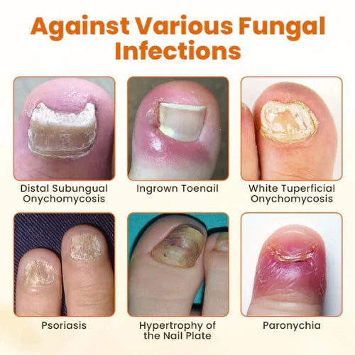 FungiBee Spray reparador de Unhas
