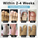 Caneta de soro de recuperação de Unhas ATTDX® MycoStop