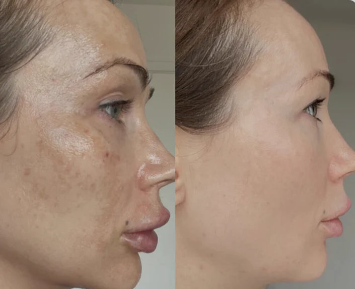 Essência Anti-hiperpigmentação Avançada MelantraX
