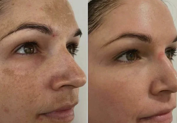 Essência Anti-hiperpigmentação Avançada MelantraX
