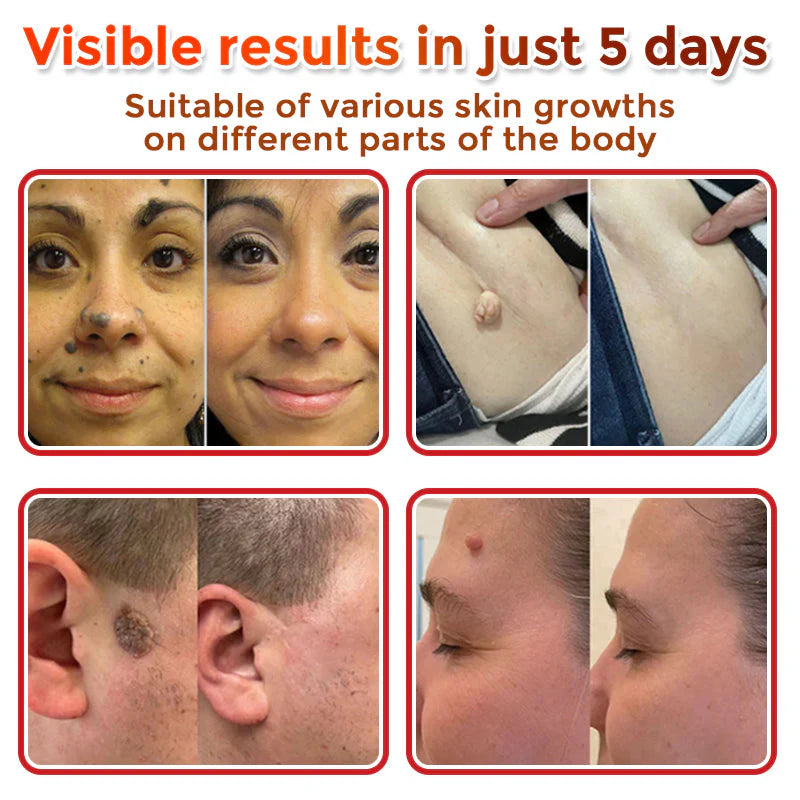 Microneedle