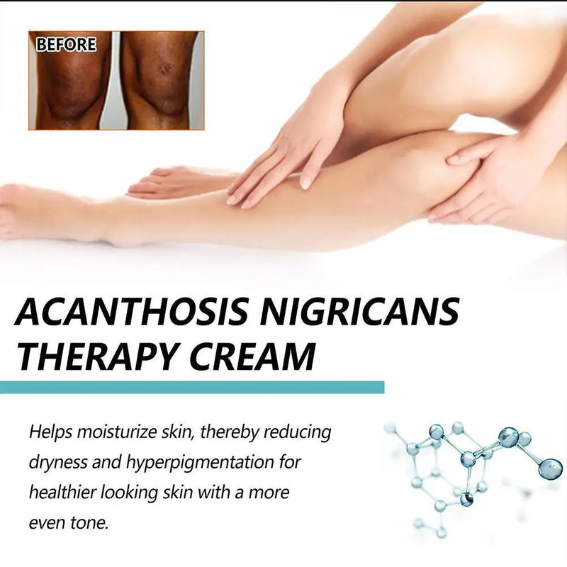 Creme Terapêutico DarkSpot Eraser