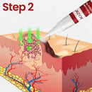 MoleGone Removedor de marcas, pintas e verrugas